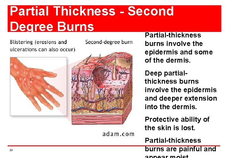 Partial Thickness - Second Degree Burns Partial-thickness burns involve the epidermis and some of