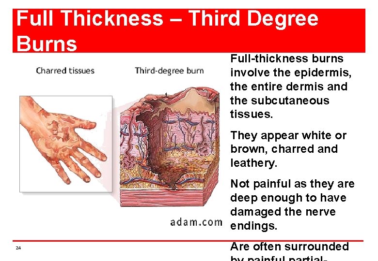 Full Thickness – Third Degree Burns Full-thickness burns involve the epidermis, the entire dermis