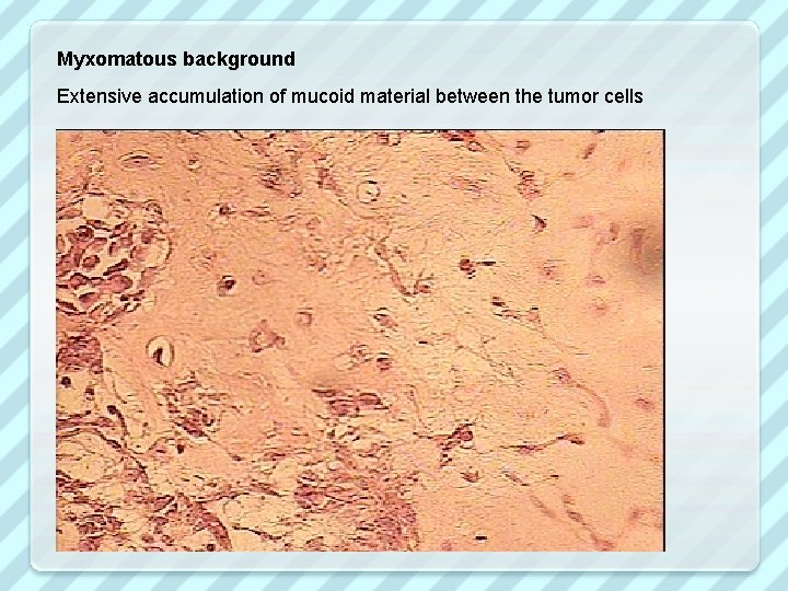 Myxomatous background Extensive accumulation of mucoid material between the tumor cells 