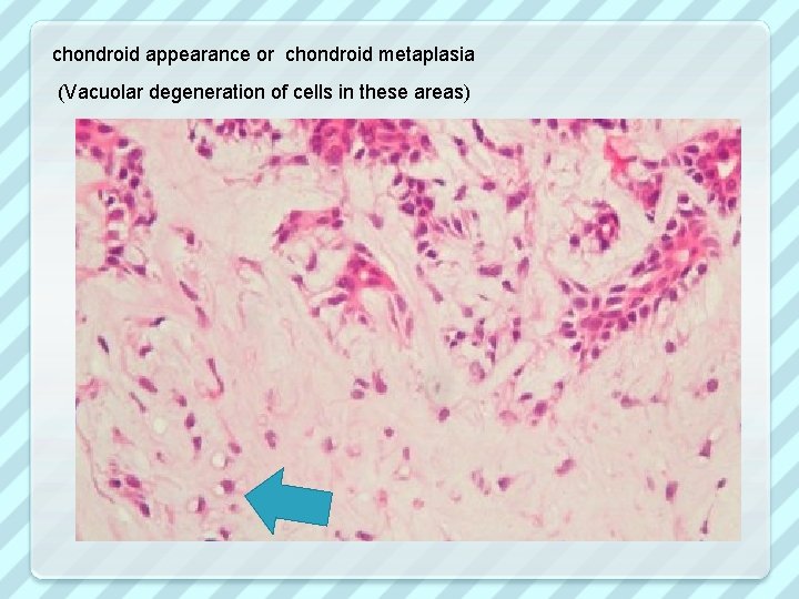 chondroid appearance or chondroid metaplasia (Vacuolar degeneration of cells in these areas) 