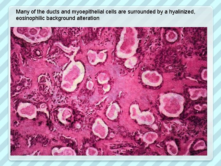 Many of the ducts and myoepithelial cells are surrounded by a hyalinized, eosinophilic background