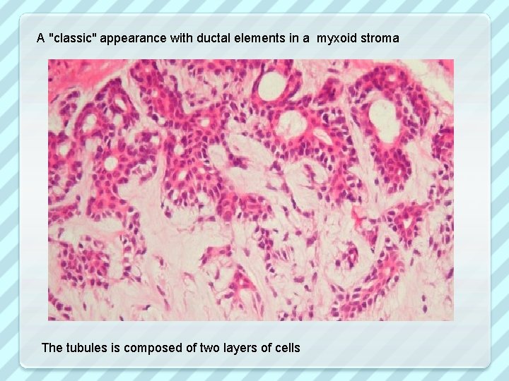 A "classic" appearance with ductal elements in a myxoid stroma The tubules is composed