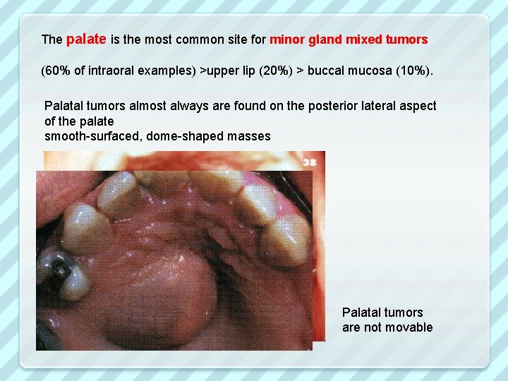 The palate is the most common site for minor gland mixed tumors (60% of