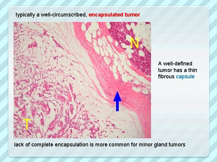 typically a well-circumscribed, encapsulated tumor A well-defined tumor has a thin fibrous capsule lack