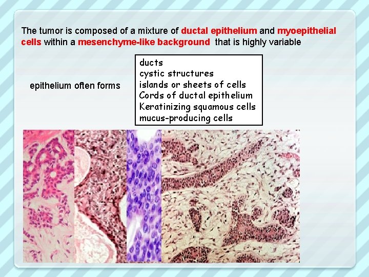 The tumor is composed of a mixture of ductal epithelium and myoepithelial cells within