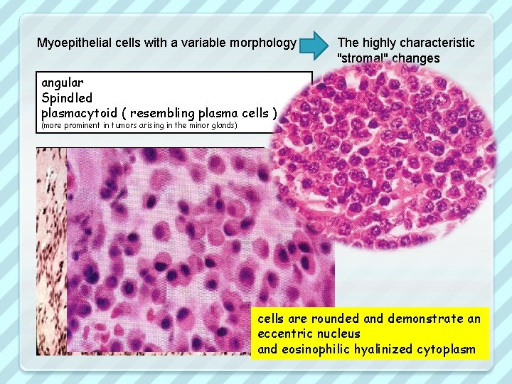 Myoepithelial cells with a variable morphology The highly characteristic "stromal" changes angular Spindled plasmacytoid