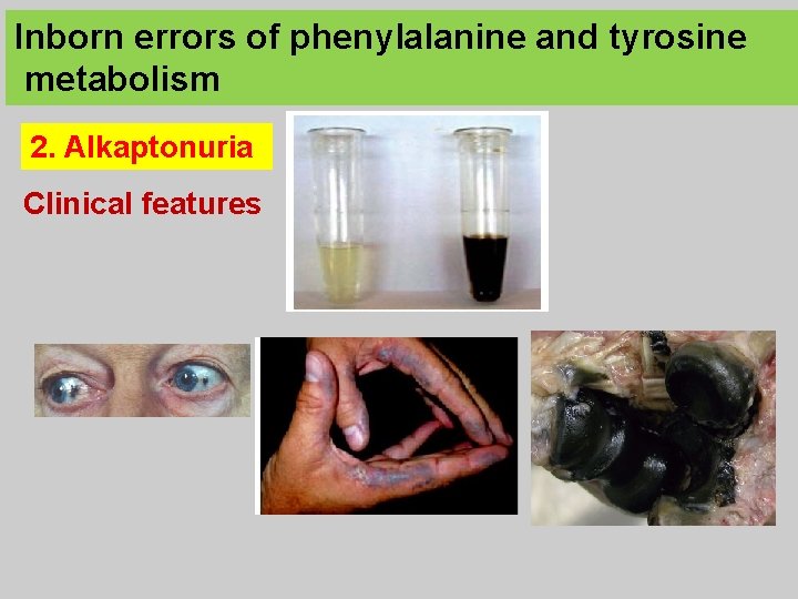 Inborn errors of phenylalanine and tyrosine metabolism 2. Alkaptonuria Clinical features 