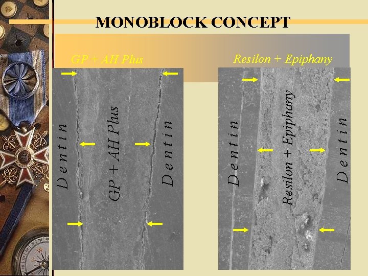 D e n t i n Resilon + Epiphany GP + AH Plus D