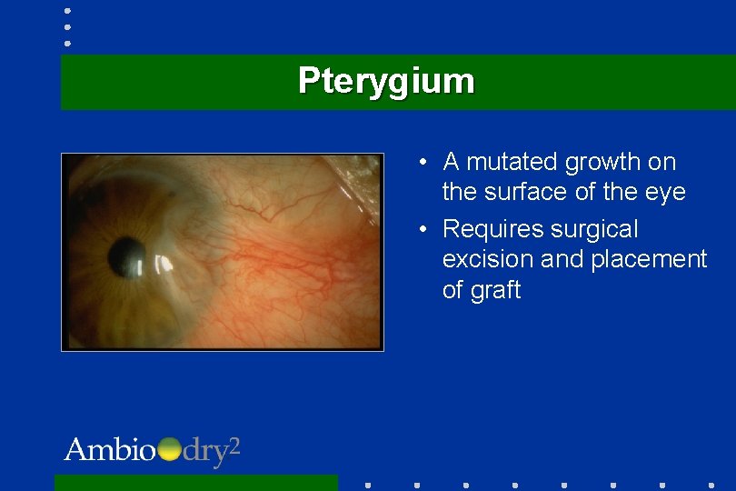 Pterygium • A mutated growth on the surface of the eye • Requires surgical