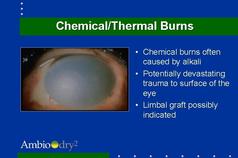 Chemical/Thermal Burns • Chemical burns often caused by alkali • Potentially devastating trauma to