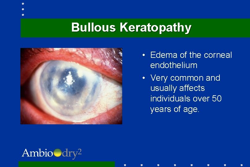 Bullous Keratopathy • Edema of the corneal endothelium • Very common and usually affects