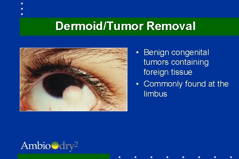 Dermoid/Tumor Removal • Benign congenital tumors containing foreign tissue • Commonly found at the