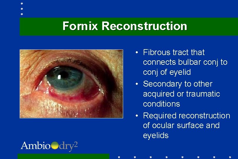 Fornix Reconstruction • Fibrous tract that connects bulbar conj to conj of eyelid •