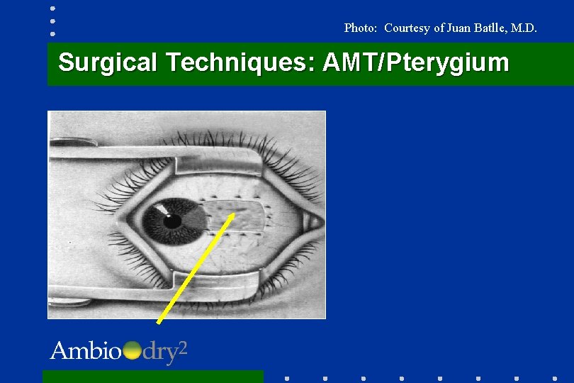 Photo: Courtesy of Juan Batlle, M. D. Surgical Techniques: AMT/Pterygium 