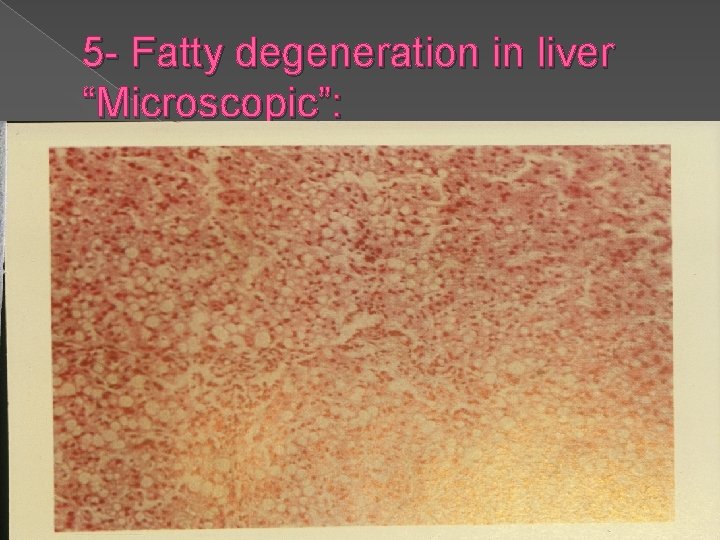 5 - Fatty degeneration in liver “Microscopic”: 