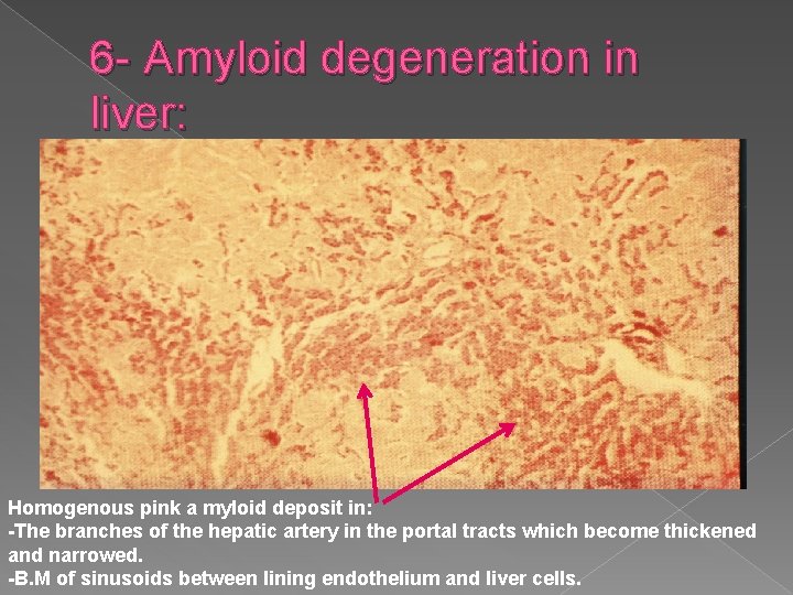 6 - Amyloid degeneration in liver: Homogenous pink a myloid deposit in: -The branches