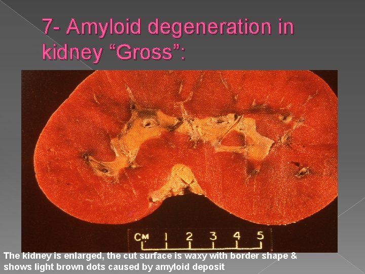 7 - Amyloid degeneration in kidney “Gross”: The kidney is enlarged, the cut surface