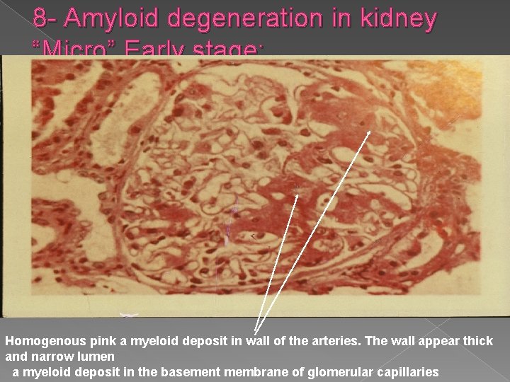 8 - Amyloid degeneration in kidney “Micro” Early stage: Homogenous pink a myeloid deposit