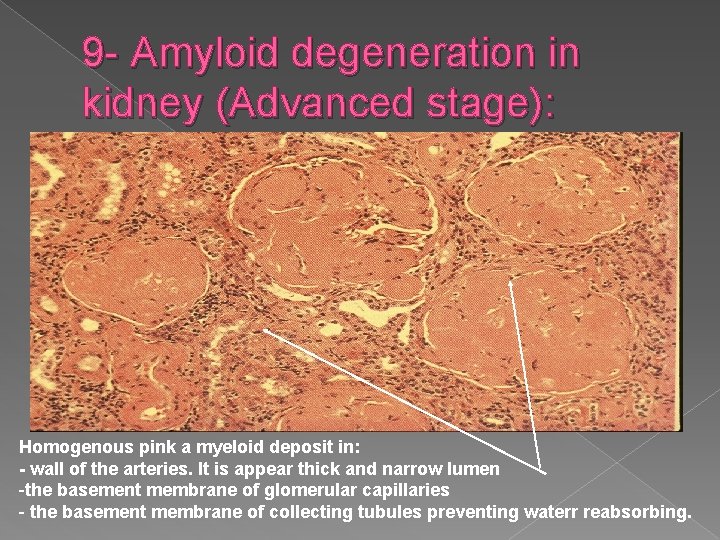 9 - Amyloid degeneration in kidney (Advanced stage): Homogenous pink a myeloid deposit in: