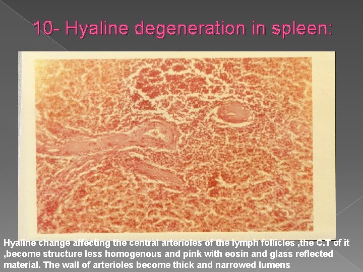 10 - Hyaline degeneration in spleen: Hyaline change affecting the central arterioles of the