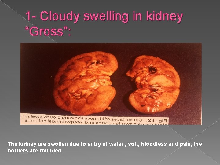 1 - Cloudy swelling in kidney “Gross”: The kidney are swollen due to entry