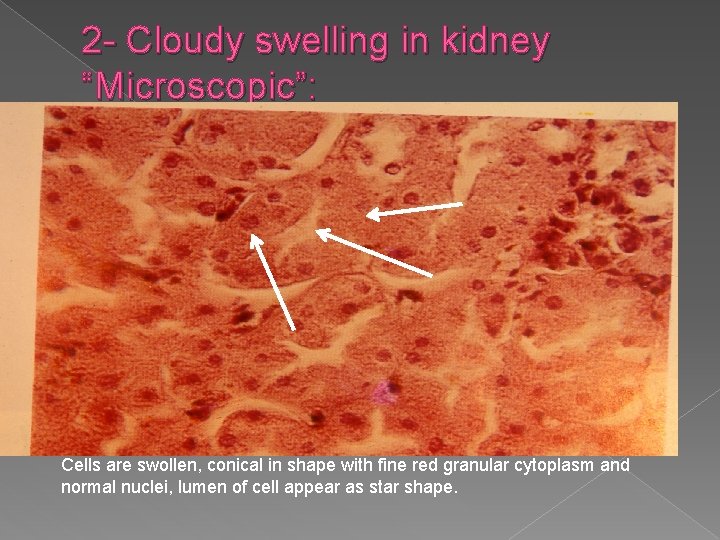 2 - Cloudy swelling in kidney “Microscopic”: Cells are swollen, conical in shape with