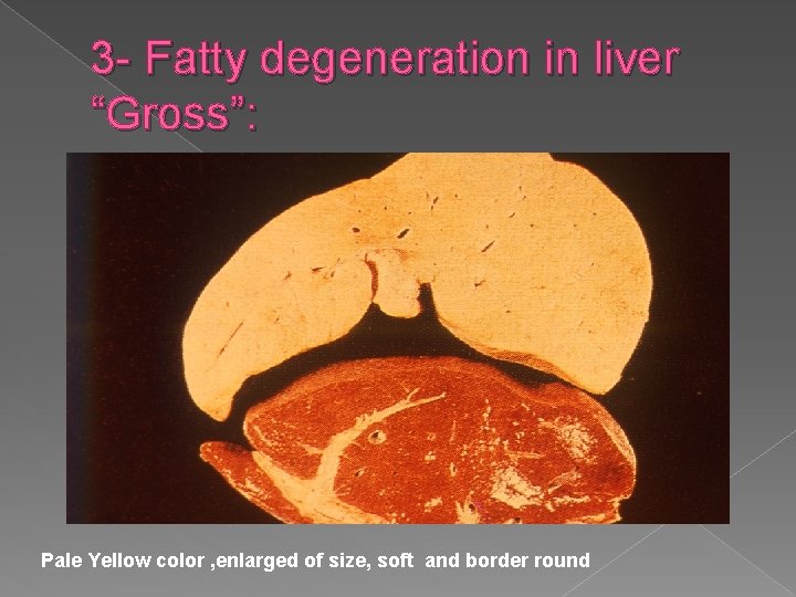 3 - Fatty degeneration in liver “Gross”: Pale Yellow color , enlarged of size,
