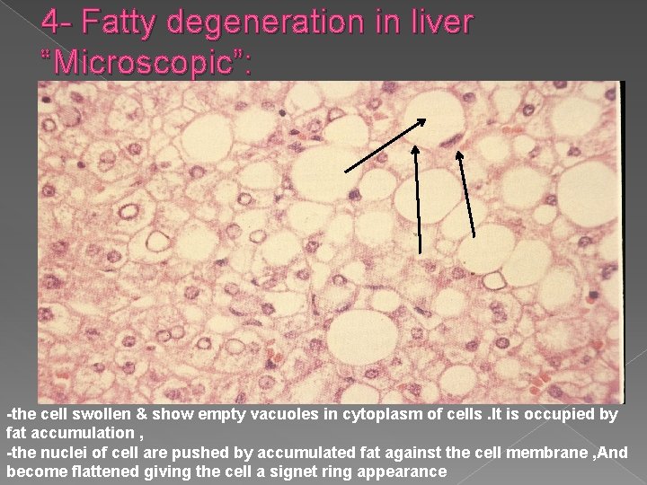 4 - Fatty degeneration in liver “Microscopic”: -the cell swollen & show empty vacuoles