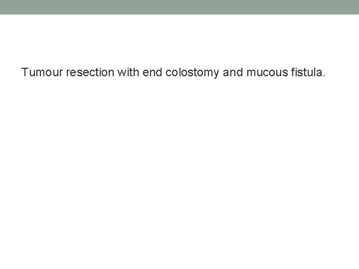 Tumour resection with end colostomy and mucous fistula. 