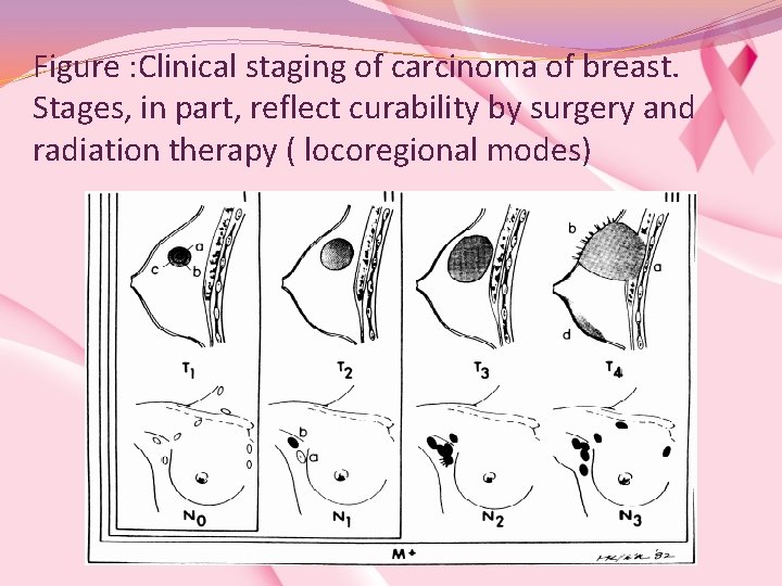 Figure : Clinical staging of carcinoma of breast. Stages, in part, reflect curability by