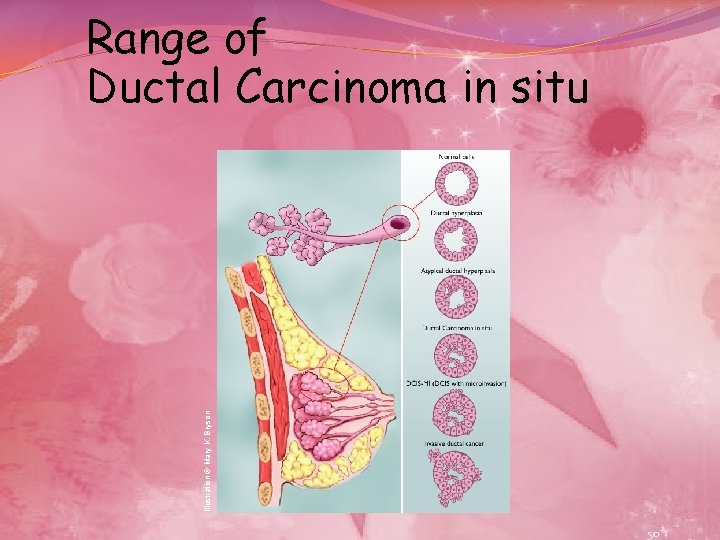 Illustration © Mary K. Bryson Range of Ductal Carcinoma in situ 50 