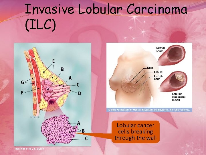 Invasive Lobular Carcinoma (ILC) Lobular cancer cells breaking through the wall Illustration © Mary