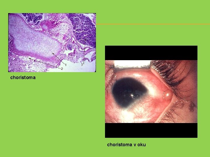 choristoma v oku 