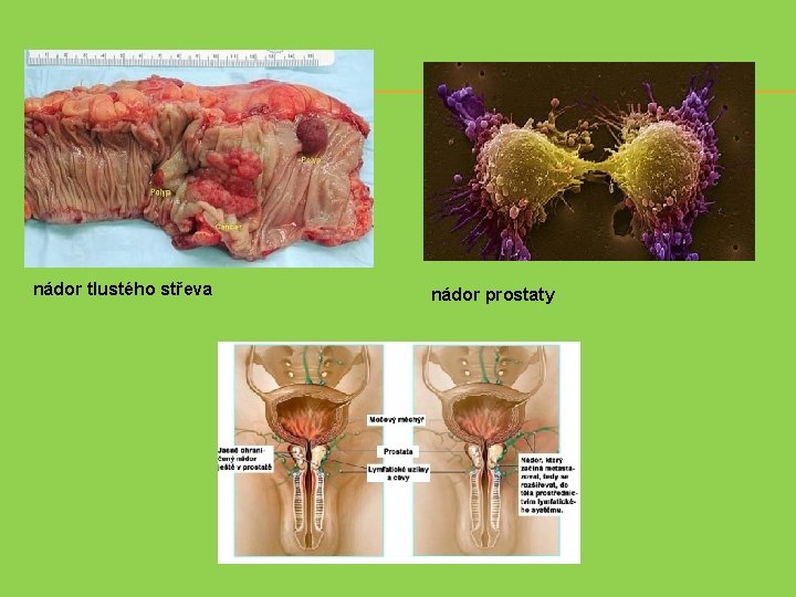 nádor tlustého střeva nádor prostaty 