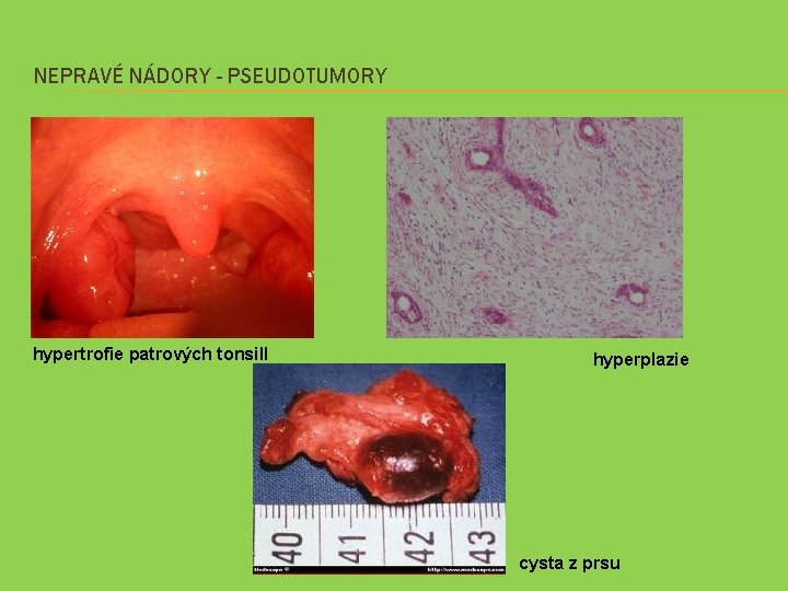 NEPRAVÉ NÁDORY - PSEUDOTUMORY hypertrofie patrových tonsill hyperplazie cysta z prsu 