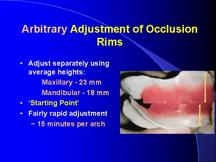 Arbitrary Adjustment of Occlusion Rims • Adjust separately using average heights: Maxillary - 23 Arbitrary Adjustment of Occlusion Rims • Adjust separately using average heights: Maxillary - 23