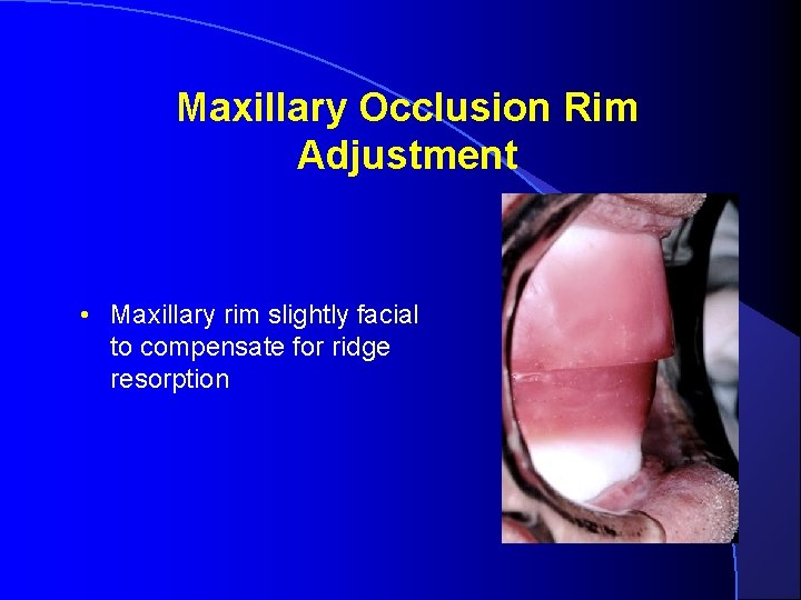 Maxillary Occlusion Rim Adjustment • Maxillary rim slightly facial to compensate for ridge resorption