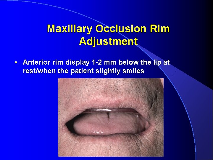 Maxillary Occlusion Rim Adjustment • Anterior rim display 1 -2 mm below the lip