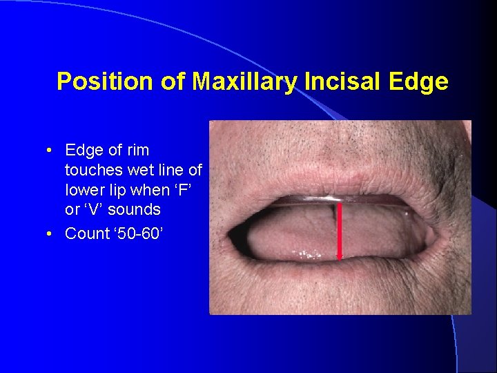Position of Maxillary Incisal Edge • Edge of rim touches wet line of lower