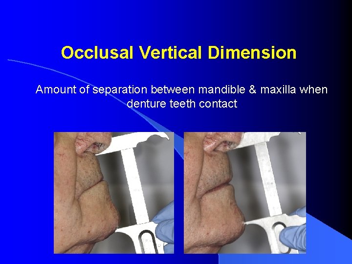 Occlusal Vertical Dimension Amount of separation between mandible & maxilla when denture teeth contact Occlusal Vertical Dimension Amount of separation between mandible & maxilla when denture teeth contact