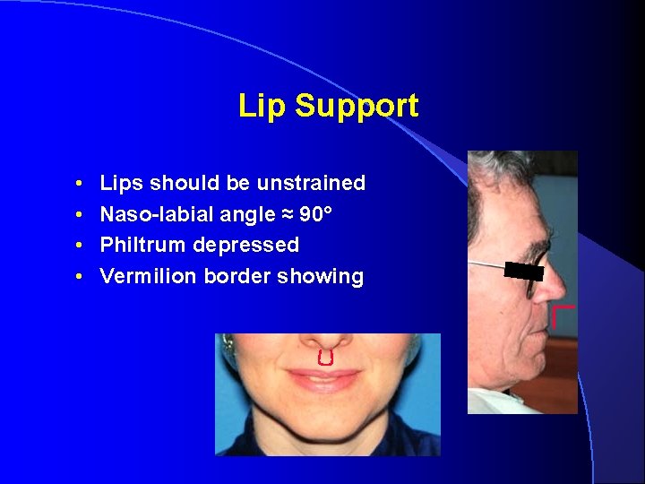 Lip Support • • Lips should be unstrained Naso-labial angle ≈ 90° Philtrum depressed