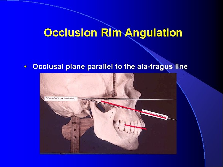 Occlusion Rim Angulation • Occlusal plane parallel to the ala-tragus line 