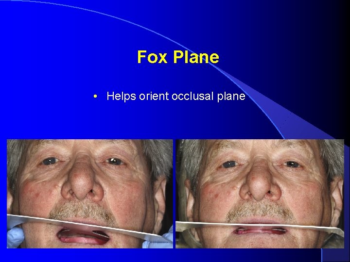 Fox Plane • Helps orient occlusal plane 