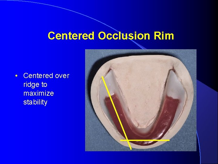 Centered Occlusion Rim • Centered over ridge to maximize stability 