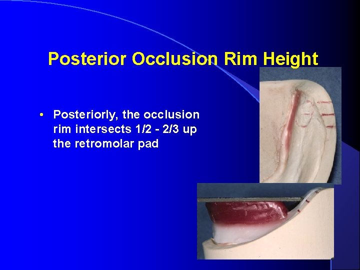 Posterior Occlusion Rim Height • Posteriorly, the occlusion rim intersects 1/2 - 2/3 up