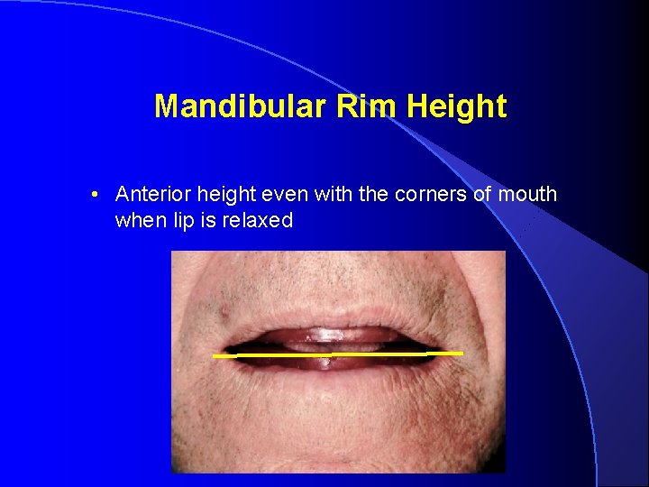 Mandibular Rim Height • Anterior height even with the corners of mouth when lip