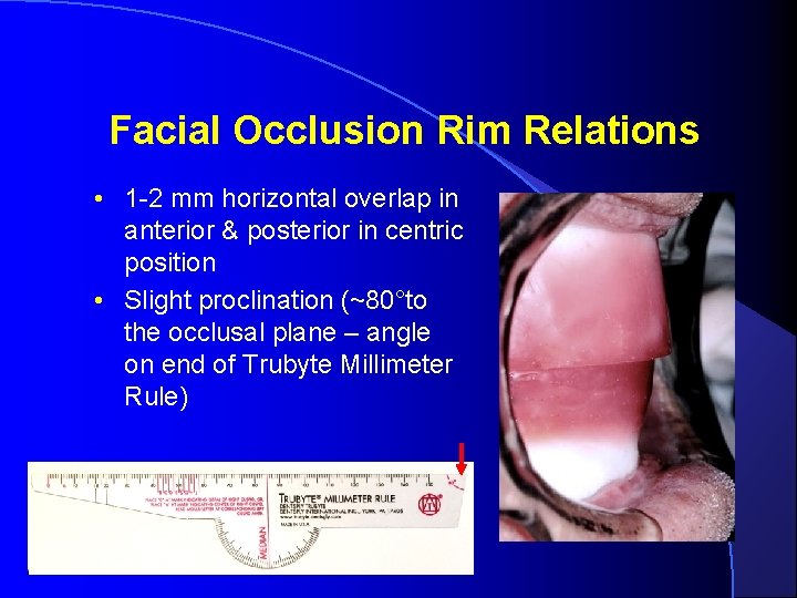 Facial Occlusion Rim Relations • 1 -2 mm horizontal overlap in anterior & posterior Facial Occlusion Rim Relations • 1 -2 mm horizontal overlap in anterior & posterior