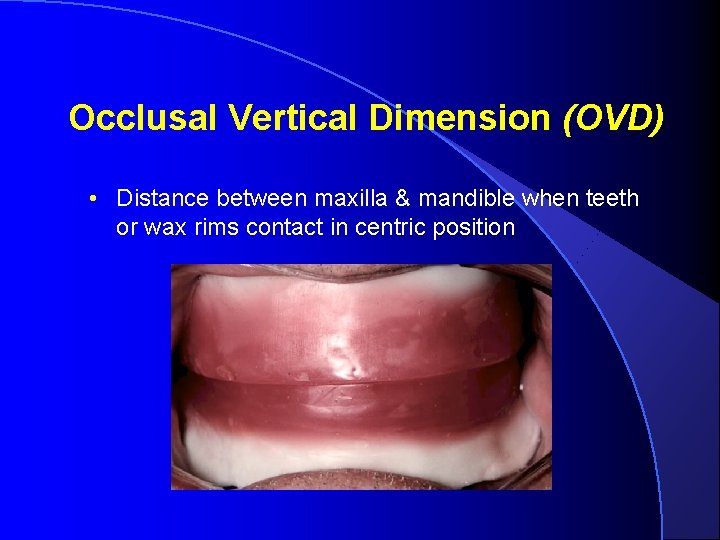 Occlusal Vertical Dimension (OVD) • Distance between maxilla & mandible when teeth or wax