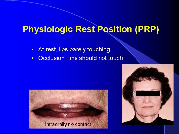 Physiologic Rest Position (PRP) • At rest, lips barely touching • Occlusion rims should Physiologic Rest Position (PRP) • At rest, lips barely touching • Occlusion rims should