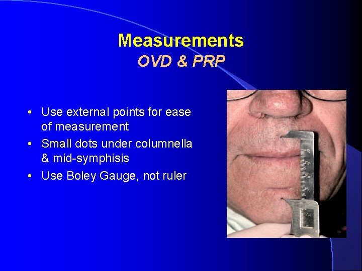 Measurements OVD & PRP • Use external points for ease of measurement • Small Measurements OVD & PRP • Use external points for ease of measurement • Small